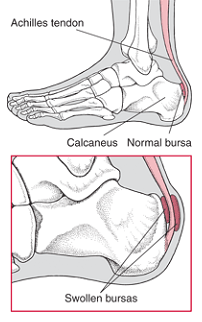 Calcaneal Spur