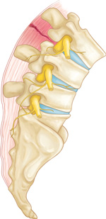 desgarre lumbar