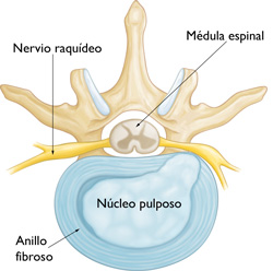 Disco Herniado ilustración