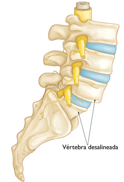 Espondilolistesis