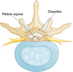 estenosis espinal