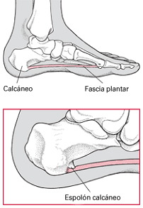¿Qué es el espolón calcáneo?