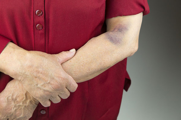 Bruise on man's elbow