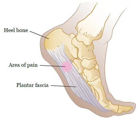 How to Relieve Heel Pain: Plantar Fasciitis Causes & Treatment